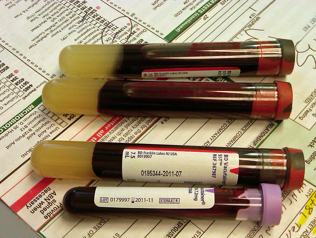 血液検査の結果で血小板が足りなかったら、「偽性血小板減少症」を疑ってみよう！